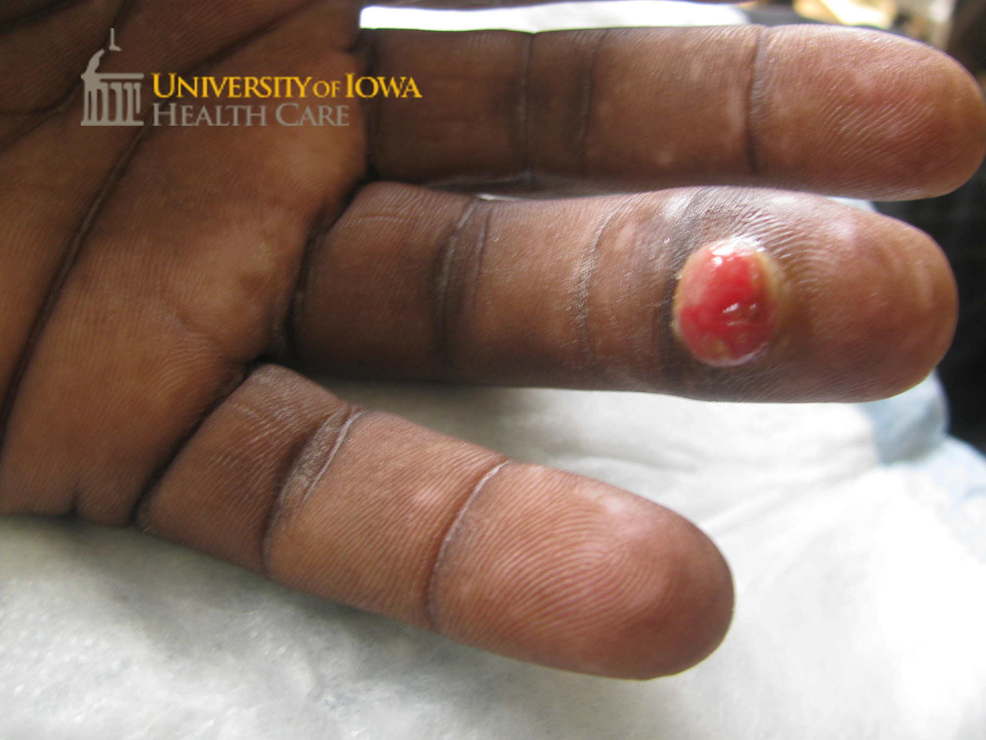 Bright red papule with collarette of scale on the 4th ventral finger. (click images for higher resolution).